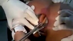 Médicos removem dildo preso no cu de mulher